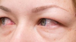 Red Glassy Eyes - HGN Test